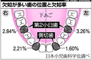 永久歯が少ない方のインビザライン治療（下顎前歯部先天性欠如）