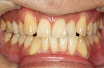 側切歯の舌側転位 治療前後の歯並び変化