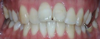 上顎右側近心位による上顎前突、上顎中切歯の唇側傾斜 治療前後の歯並び変化